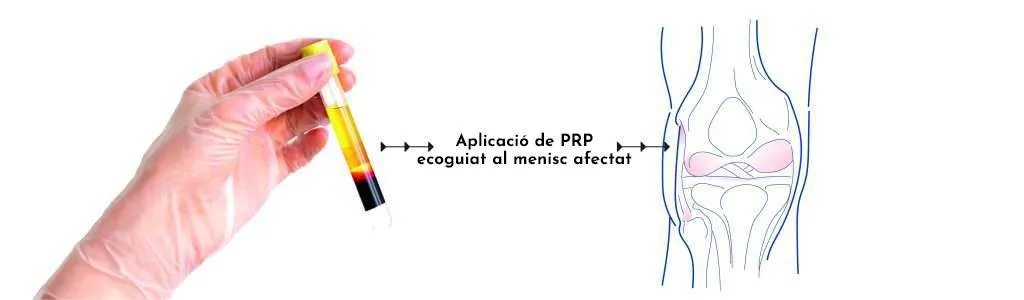 Pinçaments i lesions meniscals del genoll