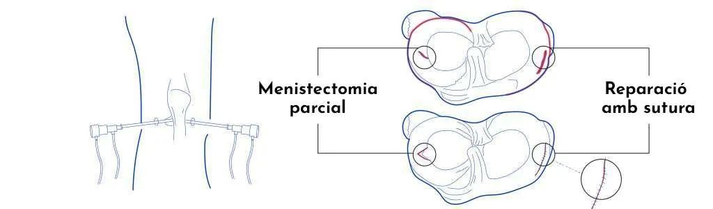 Pinçaments i lesions meniscals del genoll