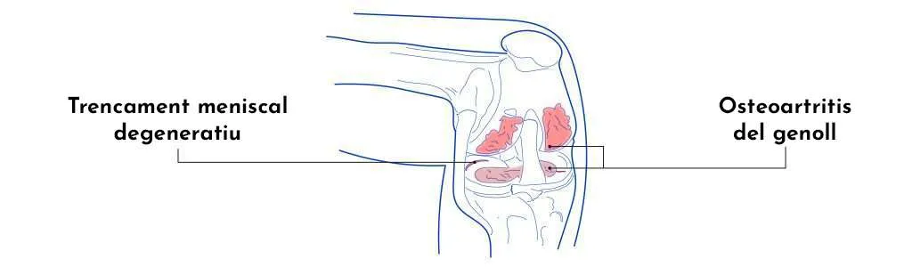 Pinçaments i lesions meniscals del genoll