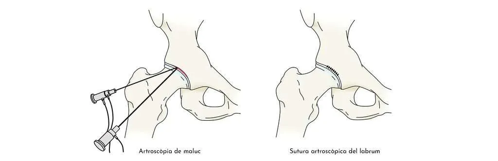 Pinçament de maluc