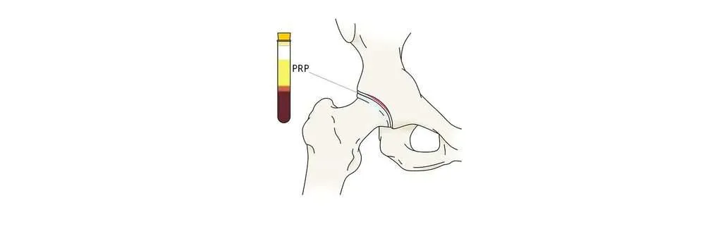 Pinçament de maluc