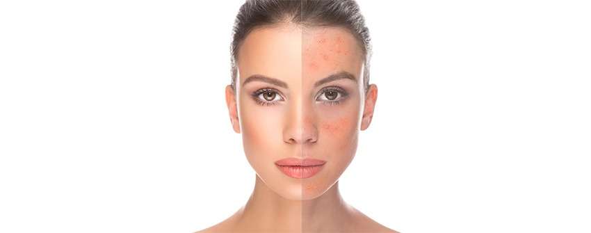 Acne, cicatrius i imperfeccions