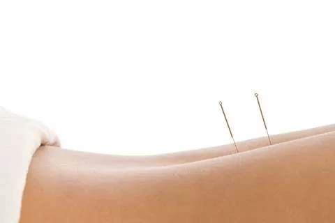 Acupuntura