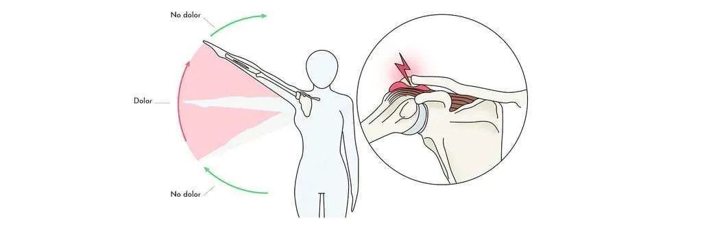 Pinçament de l’espatlla
