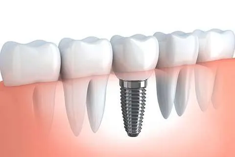Implants dentals