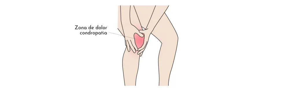 Síndrome Femororotulià