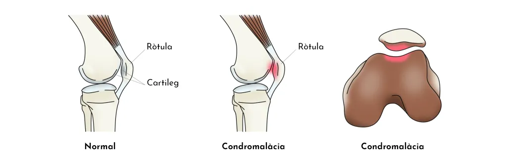 CONDROPATIA ROTULIANA
