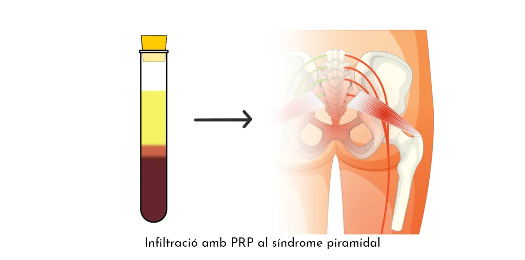 SÍNDROME PIRAMIDAL (Falsa ciàtica)