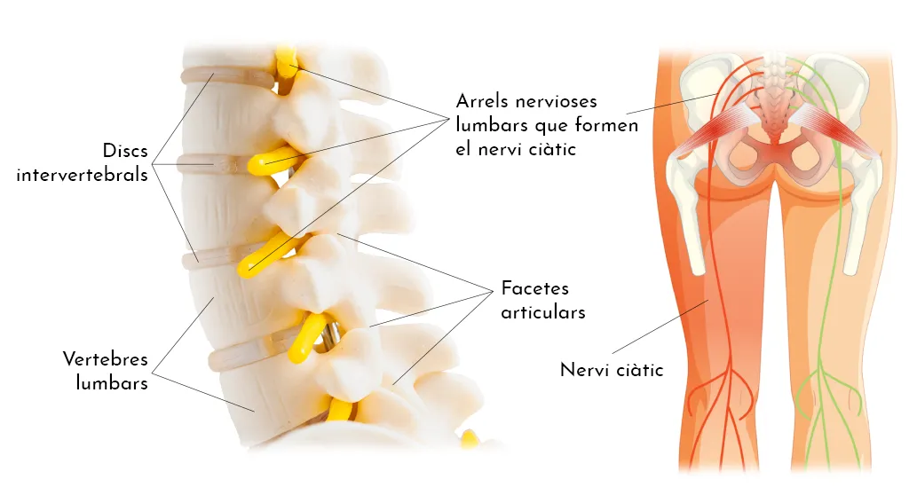 LUMBÀLGIA PER SÍNDROME FACETARI LUMBAR