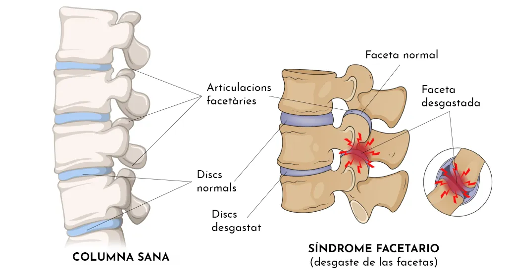 LUMBÀLGIA PER SÍNDROME FACETARI LUMBAR