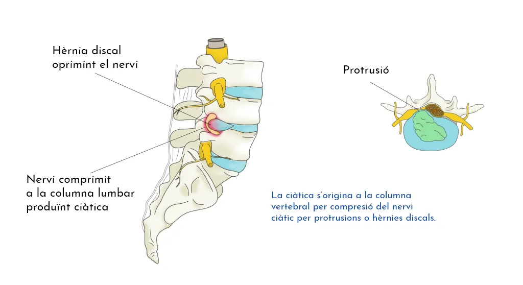 LUMBÀLGIA PER SÍNDROME FACETARI LUMBAR