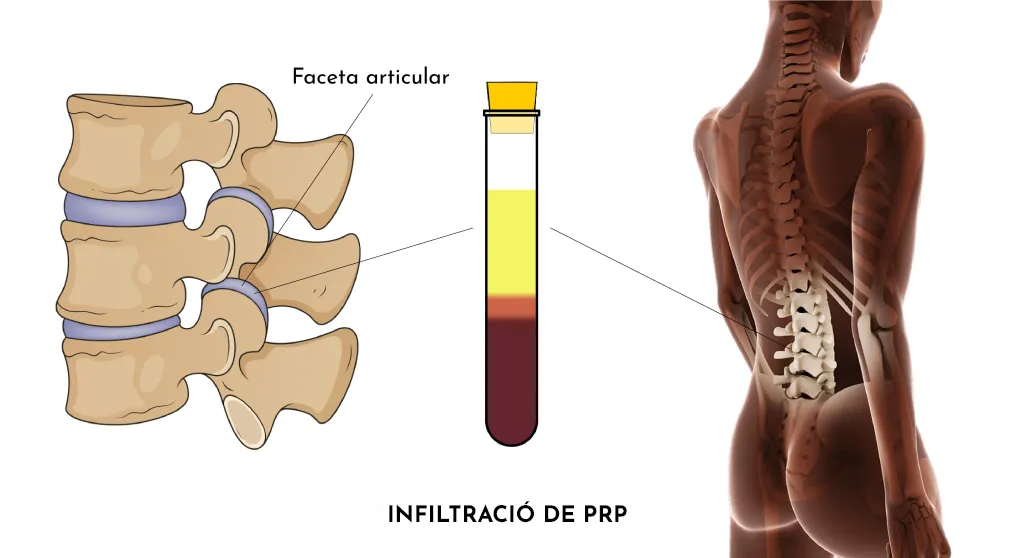 LUMBÀLGIA PER SÍNDROME FACETARI LUMBAR
