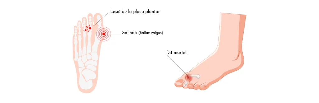 METATARSÀLGIA