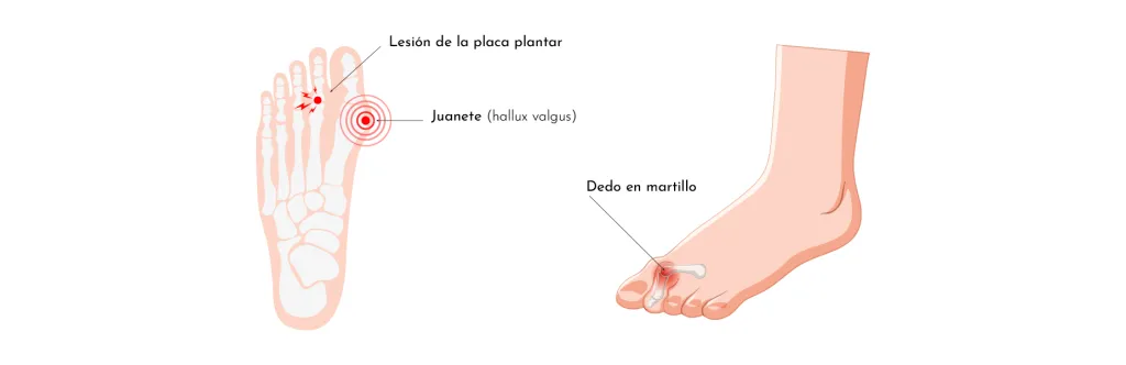 METATARSÀLGIA