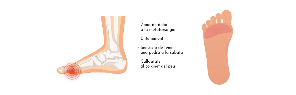 METATARSÀLGIA