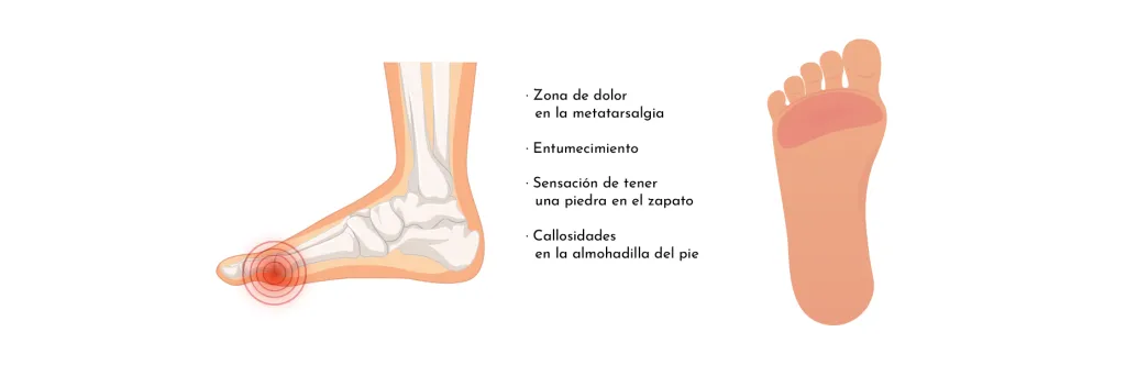 METATARSÀLGIA