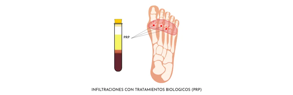 METATARSÀLGIA