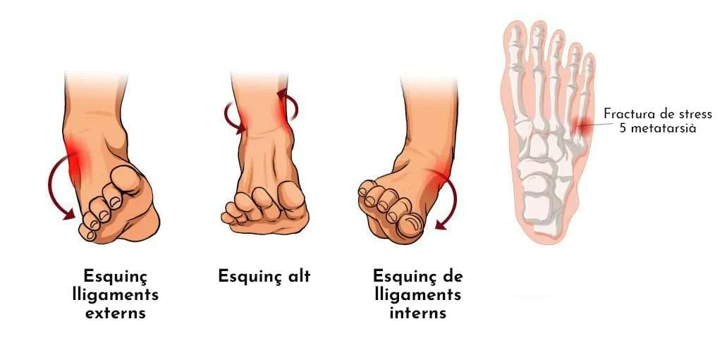 10 patologies més freqüents a l’estiu a causa de l’ús excessiu de calçat inadequat