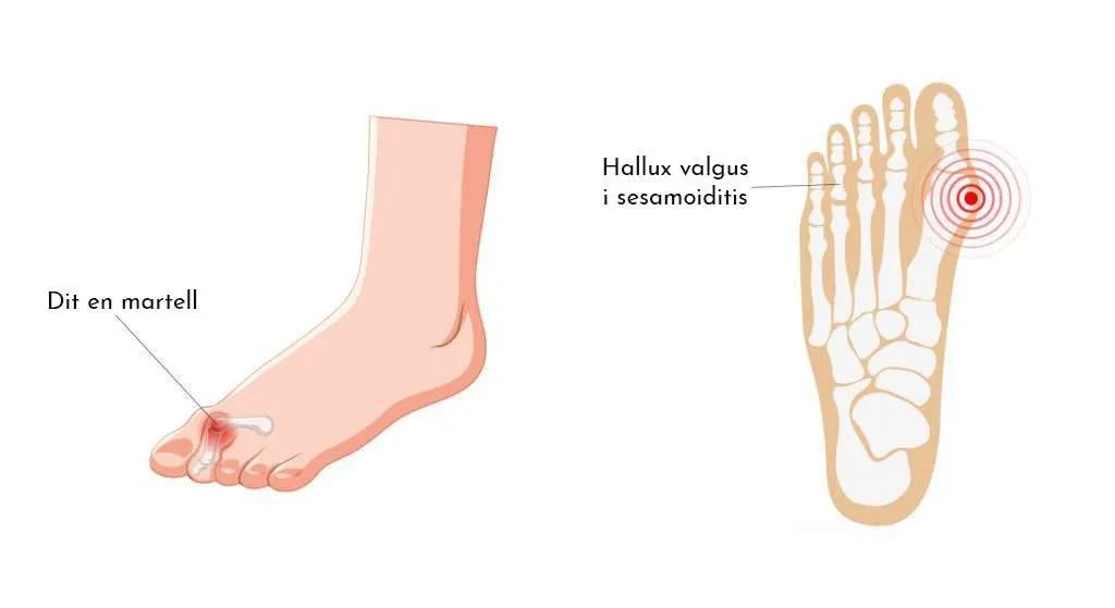 10 patologies més freqüents a l’estiu a causa de l’ús excessiu de calçat inadequat