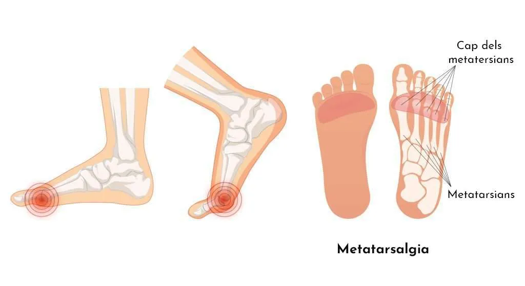 10 patologies més freqüents a l’estiu a causa de l’ús excessiu de calçat inadequat