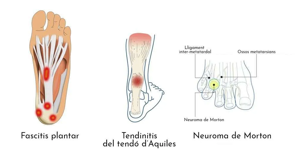 10 patologies més freqüents a l’estiu a causa de l’ús excessiu de calçat inadequat