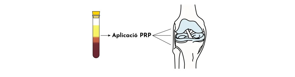 Medicina Regenerativa en artrosi: com millorar el dolor i frenar l’artrosi sense medicaments ni cirurgia