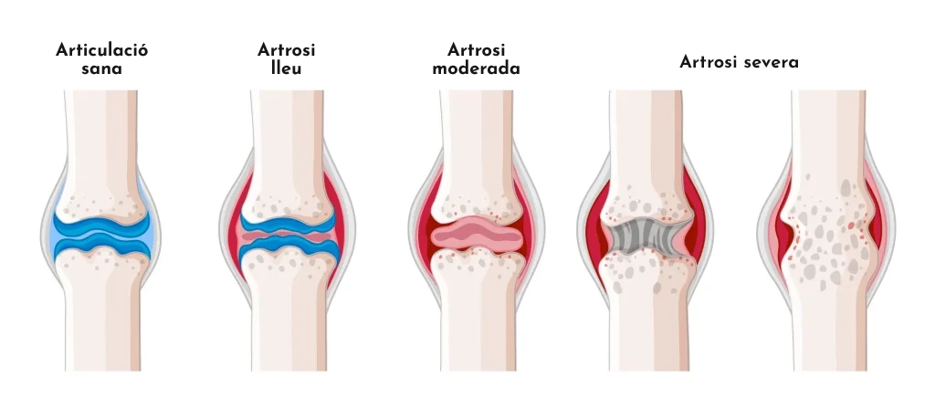 Artrosi i dolor crònic: causes, símptomes i solucions