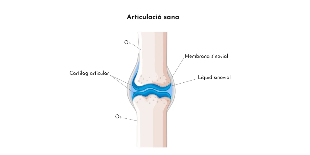 Artrosi i dolor crònic: causes, símptomes i solucions