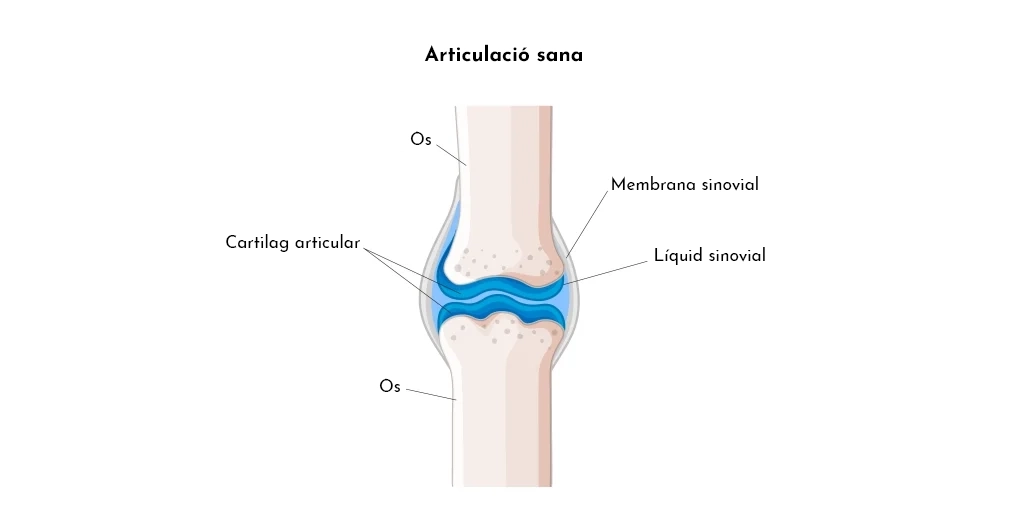 Quina diferència hi ha entre artrosi, artritis i osteoporosi? T’ho expliquem de manera clara.