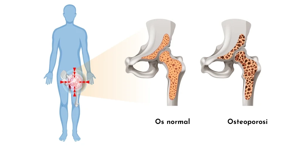 Quina diferència hi ha entre artrosi, artritis i osteoporosi? T’ho expliquem de manera clara.