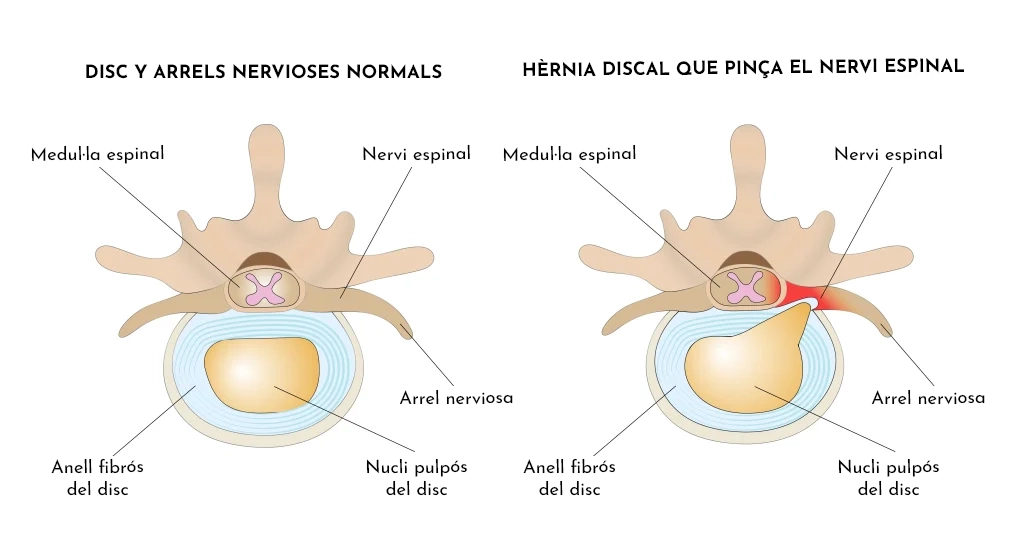 Protrusions, hèrnies discals i lumbociàtica