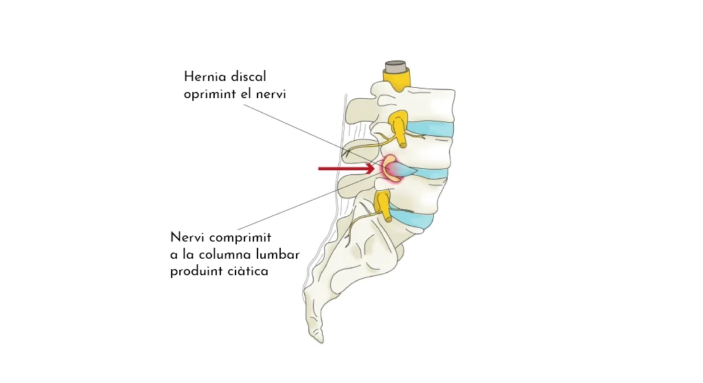 Protrusions, hèrnies discals i lumbociàtica