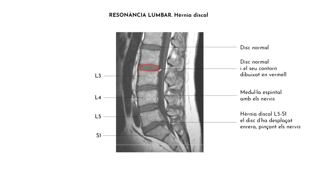 Protrusions, hèrnies discals i lumbociàtica