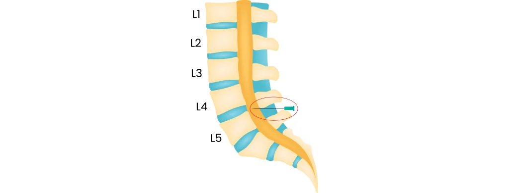 Medicina Regenerativa: quan el tractament convencional no millora i volem evitar la cirurgia