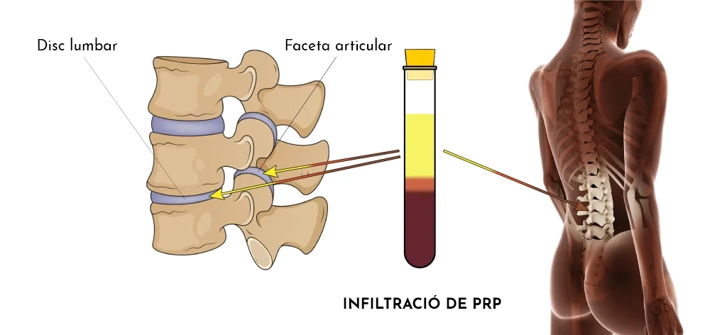 Medicina Regenerativa: quan el tractament convencional no millora i volem evitar la cirurgia
