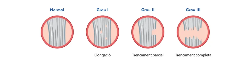 Esquinç agut de turmell: tipus, símptomes i tractaments