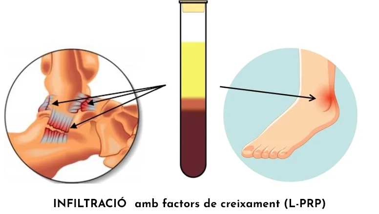Lesió de turmell. Tractaments regeneratius infiltrats. Alternatives a la cirurgia
