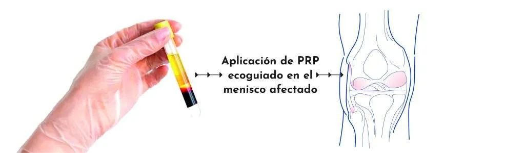 Pinzamientos y lesiones meniscales de la rodilla