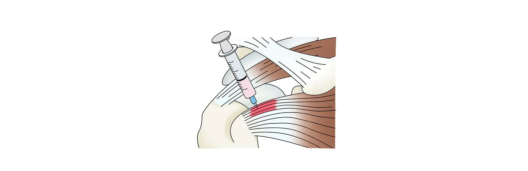 Pinzamiento de hombro