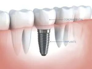 implantes dentales grup policlinic