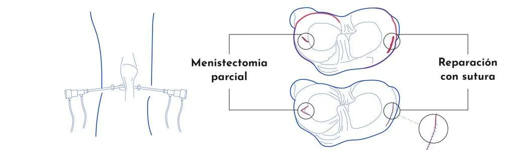 Pinzamientos y lesiones meniscales de la rodilla