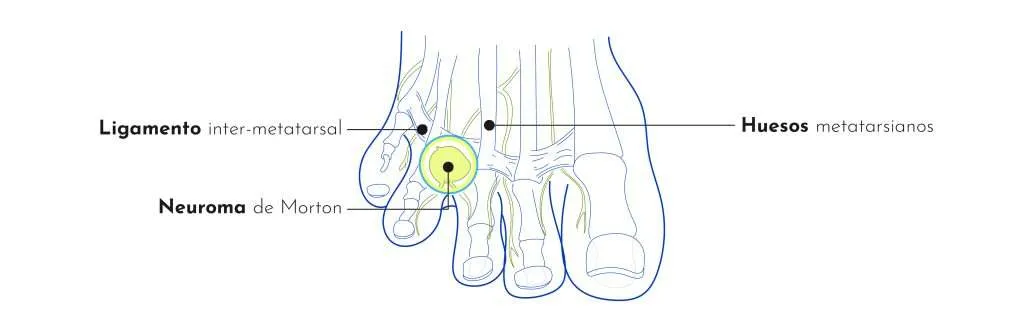 Neuroma de Morton