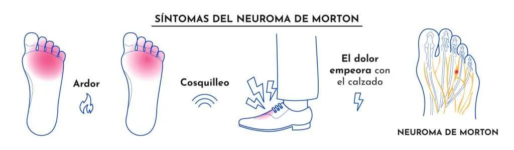Neuroma de Morton