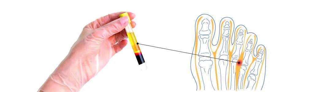Neuroma de Morton