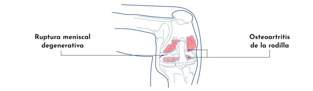 Pinzamientos y lesiones meniscales de la rodilla