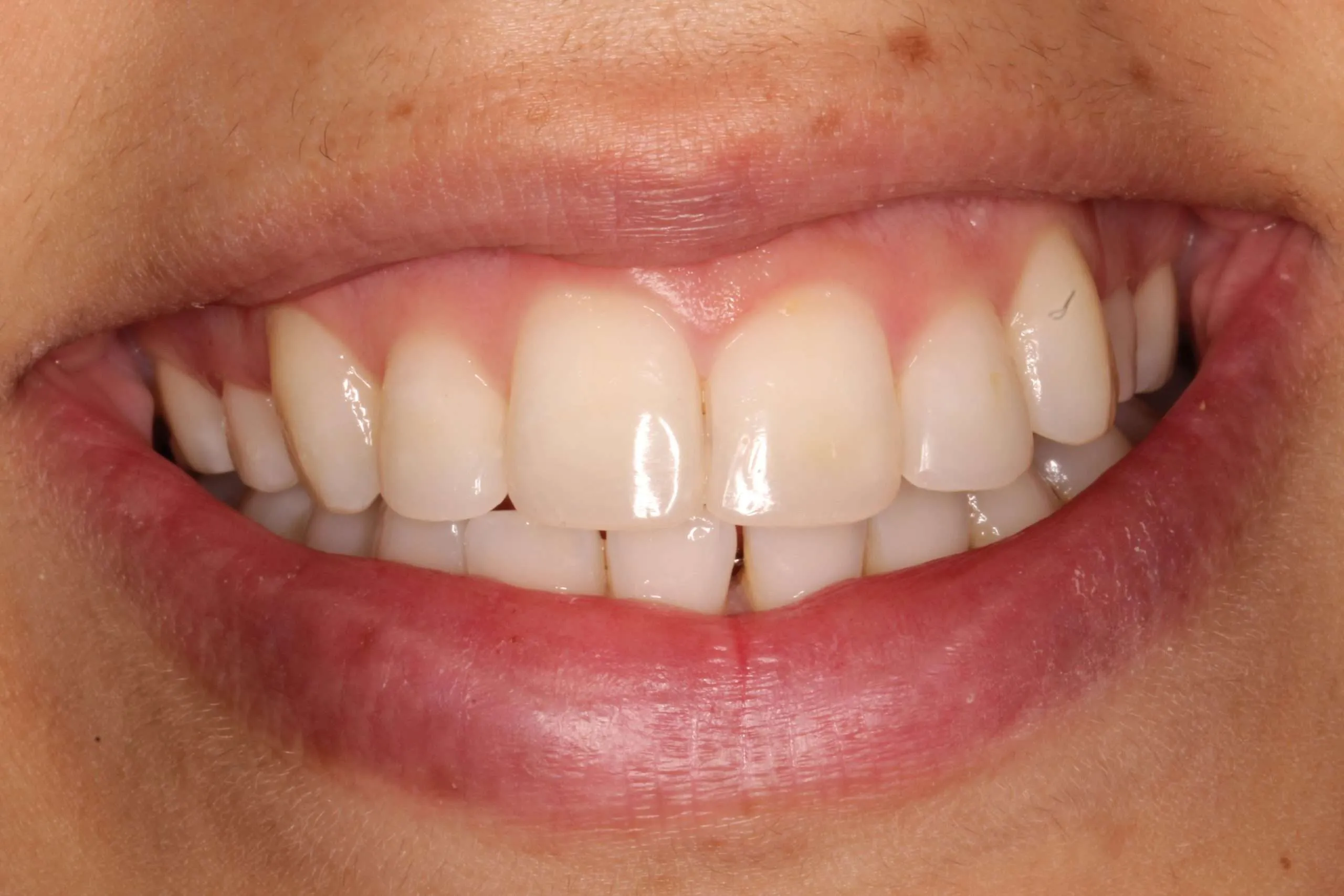 El diseño de la sonrisa