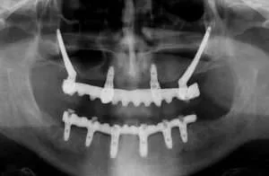 implantes dentales zigomaticos