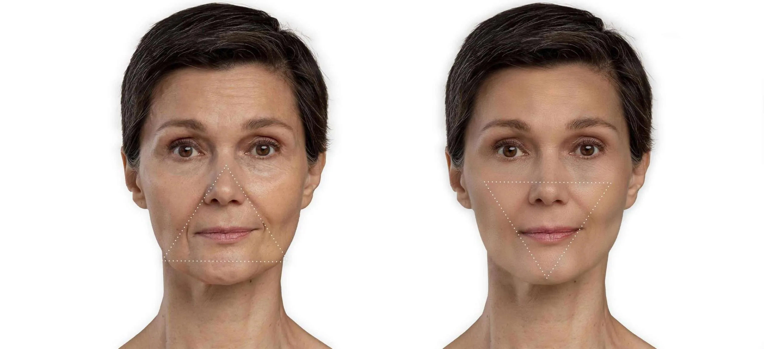 Triángulo de la belleza, la ciencia detrás de un rostro más joven