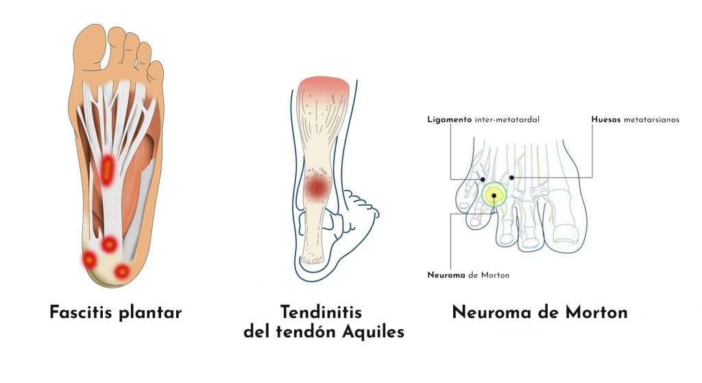 pies-posibles-soluciones-grup-policlinic