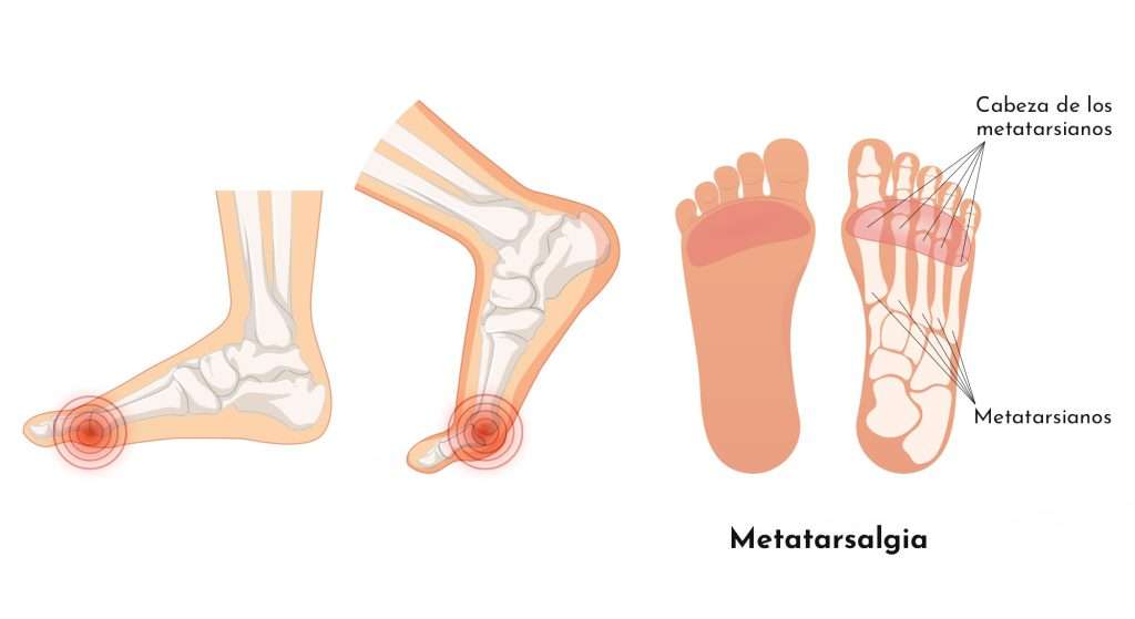 pies-posibles-soluciones-metatarsalgias-grup-policlinic
